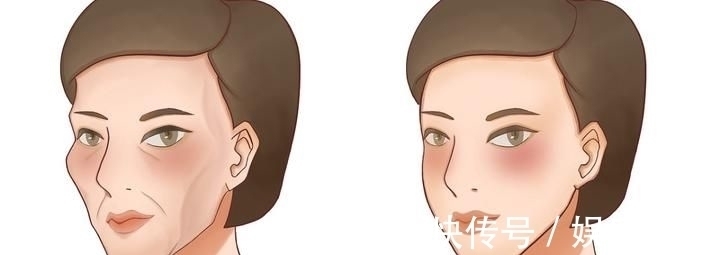 面部填充 王小民教授:做完面部填充后,脸真的变小了?