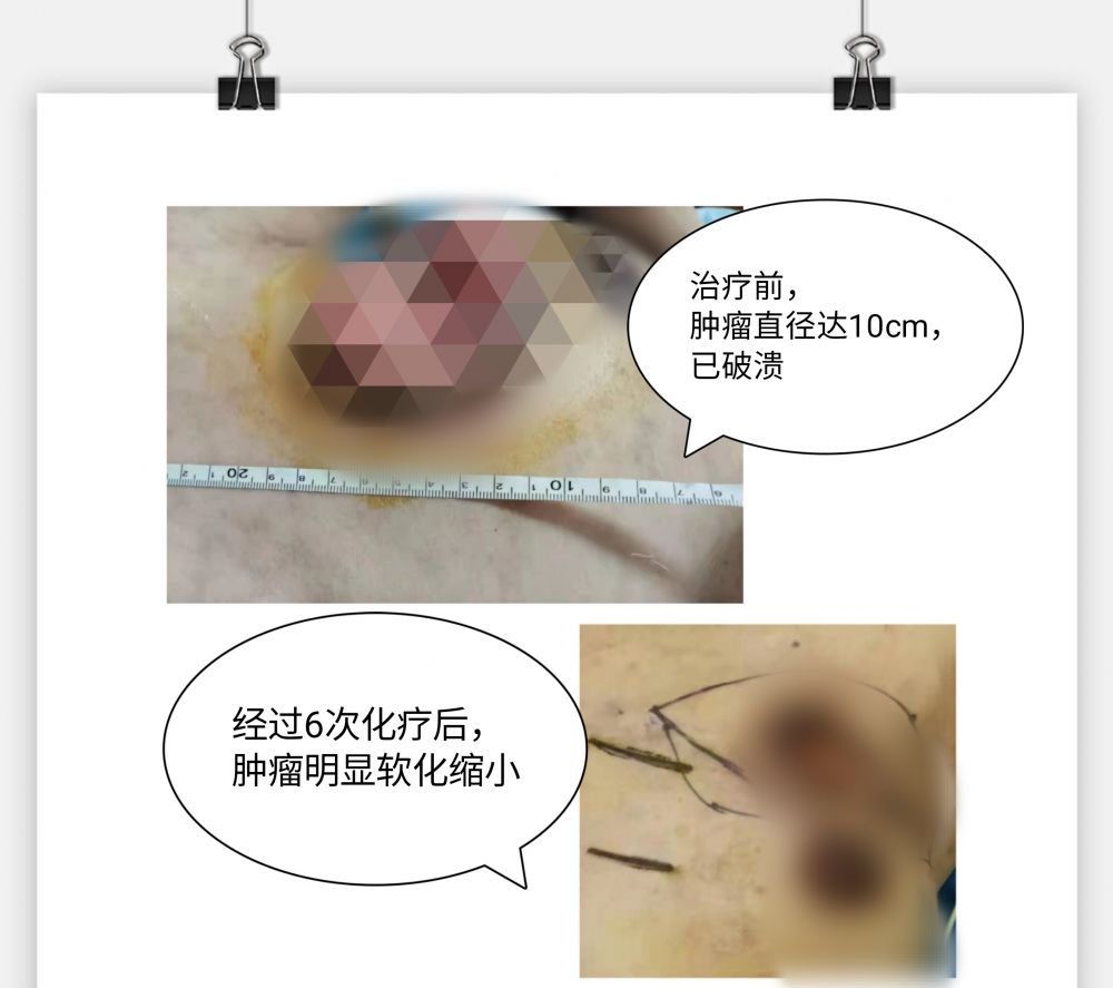 保乳|重医二院·聚焦前沿｜第41期 乳腺癌还在“一切了之”？保乳与保命不再两难