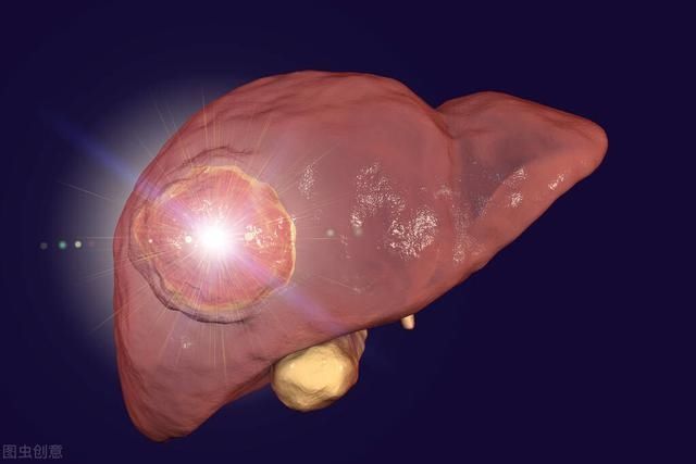 肩部|48岁男子误以为肩周炎，却查出肝癌肩膀若突现这1症状，别拖延