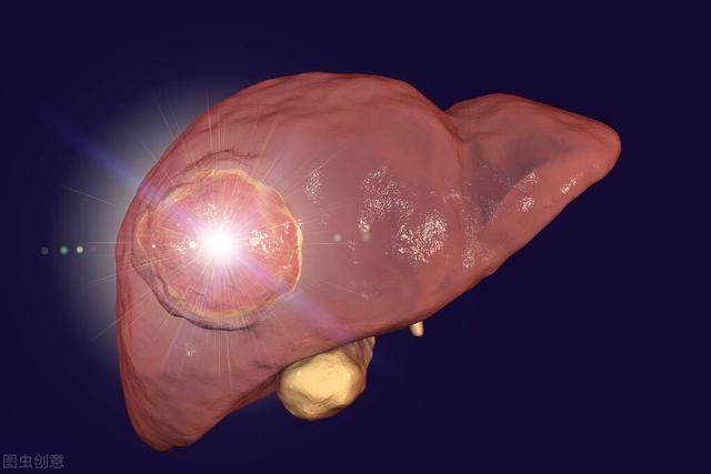肩部|48岁男子误以为肩周炎,却查出肝癌肩膀若突现这1症状,别拖延
