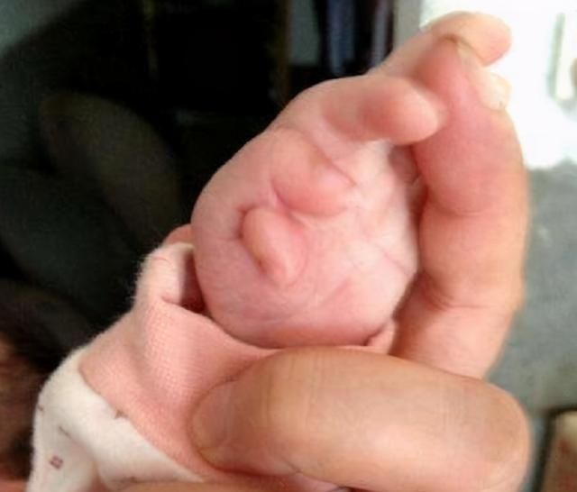 检查|四维检查宝宝畸形,孕妈却执意生下孩子,出生后全家“沸腾了”