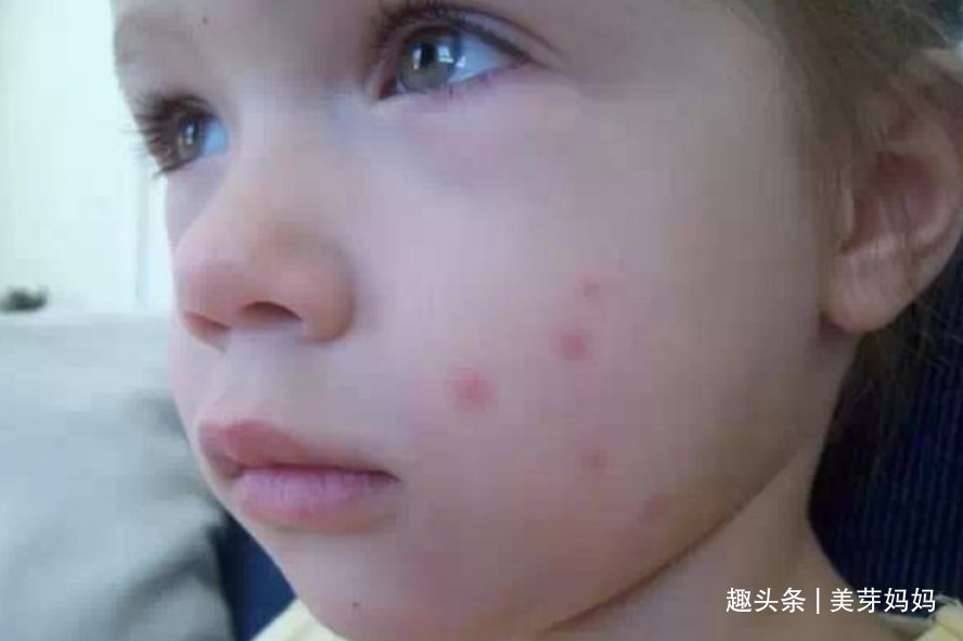 止痒|宝宝被蚊子叮咬后,第一步不是帮娃止痒,很多家长都做错了
