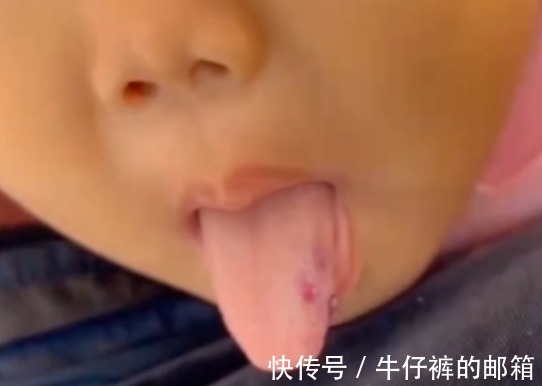 淤青|一岁多女童不幸确诊,身体布满淤青及口腔有瘀血,全家人崩溃了
