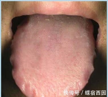 中医内科学|有冠心病的人，舌头有三种“凶相”！