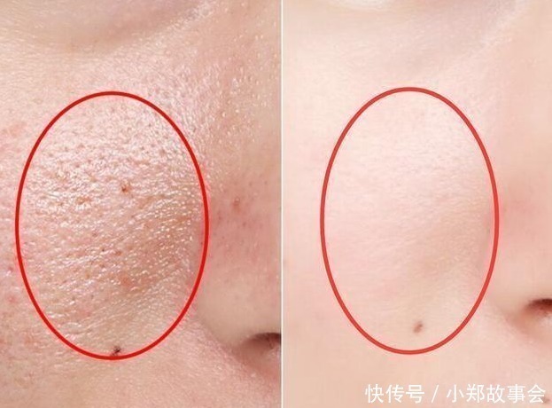 黑头|先别慌着挤黑头,这3种原因你知道了再挤也不迟