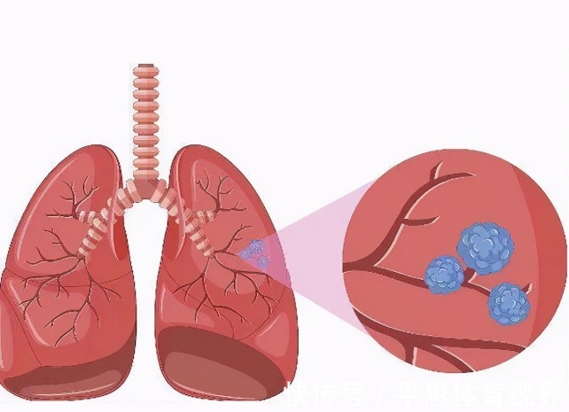 医生|为何“肺结节”越来越多？医生劝说：3种食物少碰，肺会感谢你