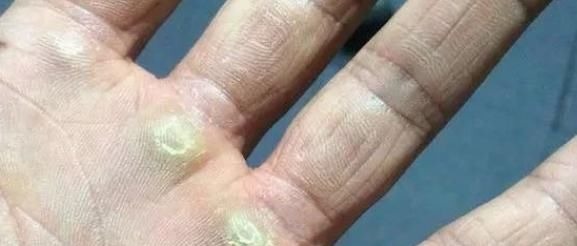 茧子|脚上长“茧子”和疾病有关？若脚上出现4种茧子，一定要留意了！