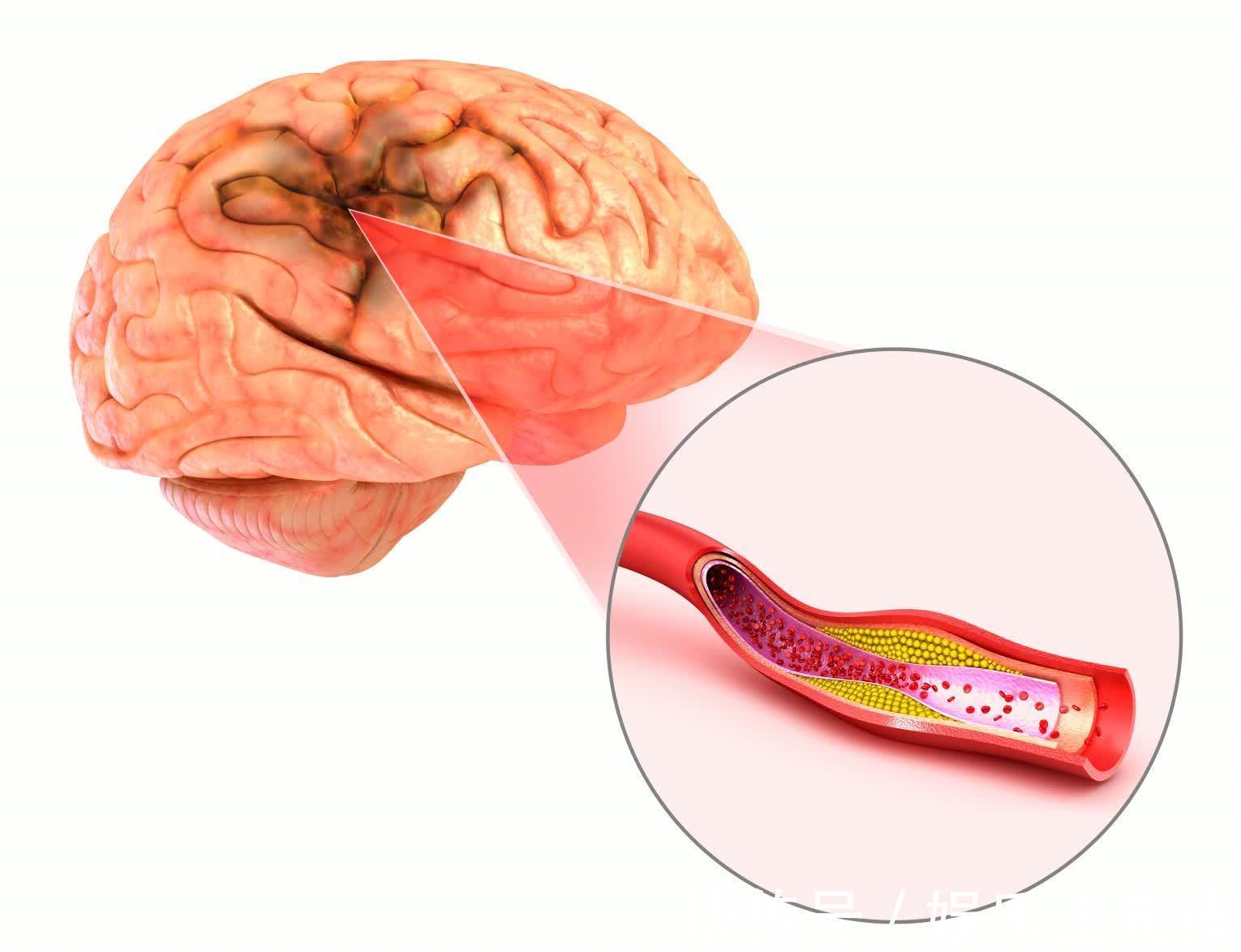 绝招|经常头晕心悸？很可能是血压超标了！3个绝招轻松控制血压
