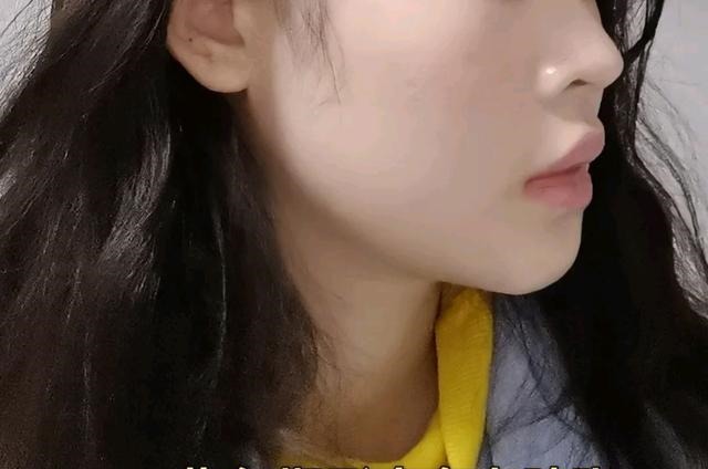 假体 假体下巴这个手术对下庭改善大吗!