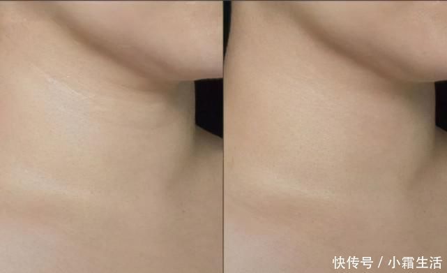 医生|脖子处皮肤松弛严重,皱纹明显!做哪些项目比较好?医生仔细盘点