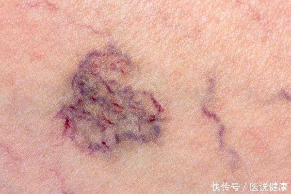 信号|血栓近身的5个信号,若占两个以上,建议你尽快去检查,别拖!