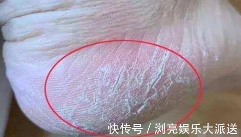 代谢|肝不好,脚部会有3种异常,若你全中,可能是肝“撑不住了”