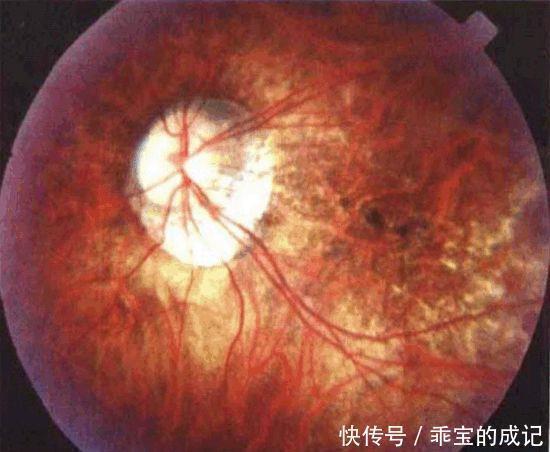 玻璃膜|近视超过600+？我建议你看看自己的眼底，绝对惊恐！