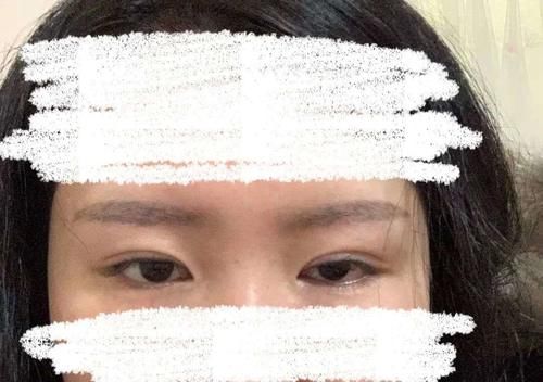 五年四次手术,卷入消费贷,患上抑郁症,我的黑医美往事