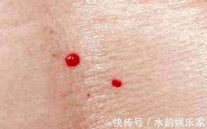 病变|肝脏没有痛觉,发现就是晚期!手上出现3种信号,提示你病变了