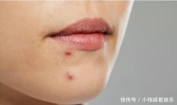 防晒|脸上残留“红色痘印”,你却还在疯狂“美白”?怪不得消不下去