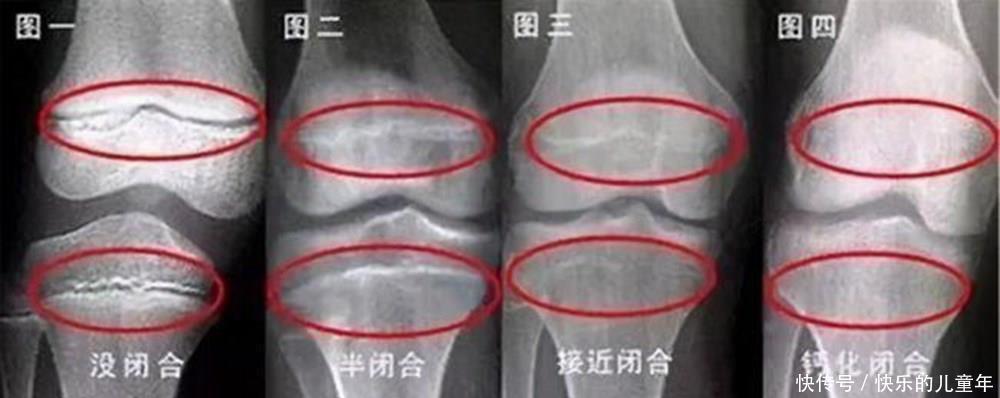 骨骺线|当男孩出现这些特征,暗示到了长高“天花板”,和年龄关系不大