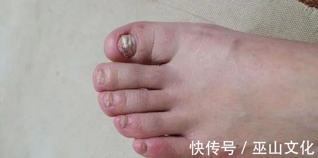 运动|血脂高不高,看小腿就懂若有这4种症状,或在暗示血脂偏高了