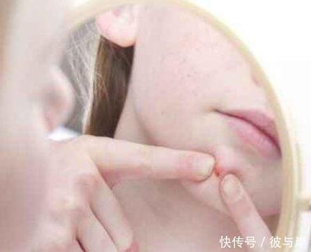 痘痘|总留痘印的人，会常常做这4件事，若你也在其中，请早点改掉