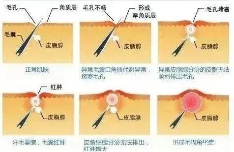 美颜都p|美颜都P不掉的“鸡皮肤”，要怎么救？这篇让你全身“纵享丝滑”