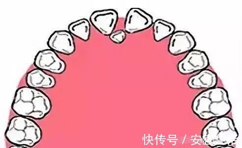 畸形|父母請注意：孩子12歲之前必須矯正的幾種牙齒畸形