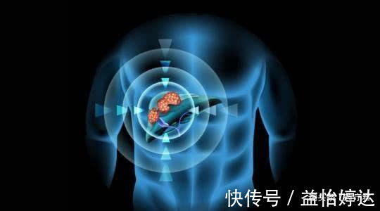 肝脏|10年间，4兄弟3人肝癌离世，医生叹息这种结局是完全可以避免的