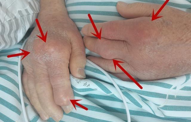 小茶方|一个可以治痛风的小茶方,简单好喝见效快,成功排出体内的尿酸