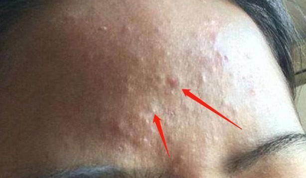 内分泌失调|子宫好的女人,脸上没有4种变化,若都没有,子宫正常