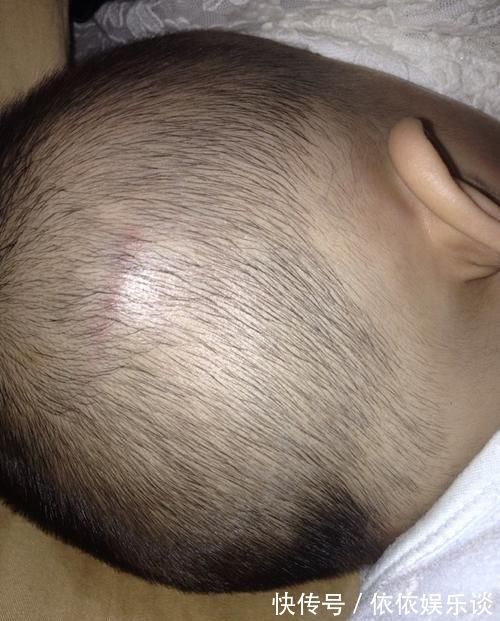 宝宝|宝宝摔倒磕到,不要以为消肿就好,有可能是颅内出血