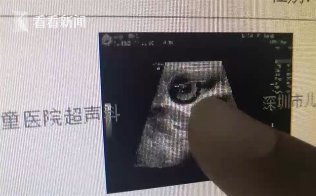 肠梗阻|1岁女童误把网红玩具当糖吞下 医生紧急手术取出