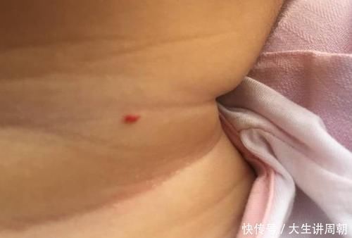 蜘蛛痣|身上突然长出这种小红痣，别大意，可能是某些疾病的预警信号