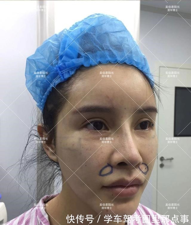 法令纹 32岁姑娘小拉皮术后7个半月,变得年轻又精致,前后反差很大!