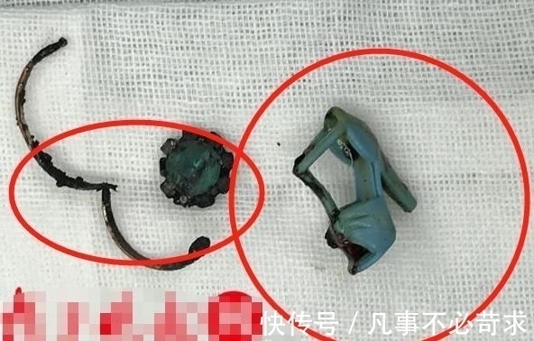 家长们|8岁男孩耳朵疼痛难忍,父母带孩子去检查,取出的东西让爸妈崩溃