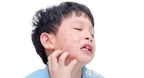 危害|皮炎危害不简单 若不认真应对终将害了你自己