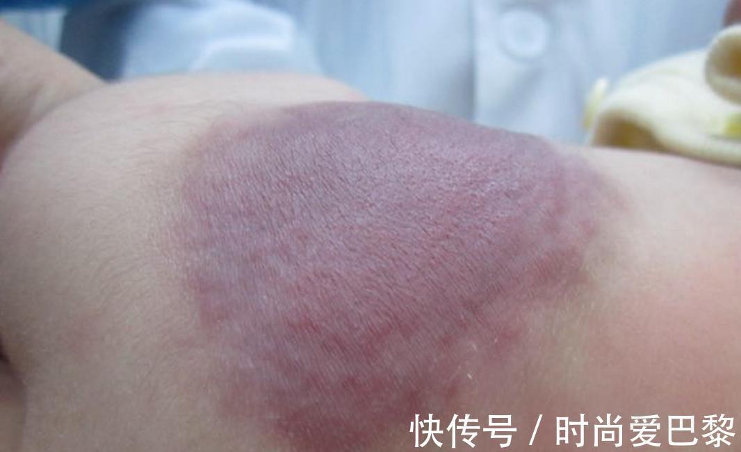 胎记|40%宝宝胎记不是来自遗传,更多是因为孕妈,孕期太放纵四个行为