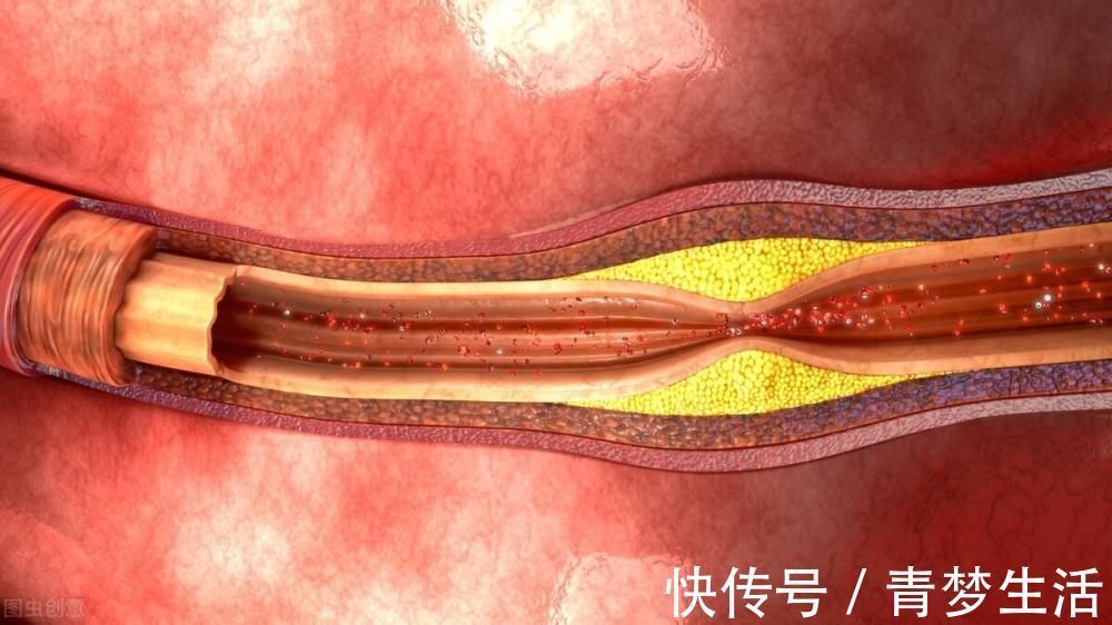 人体|高血脂的“元凶”被揭晓，并非肥肉，建议你少吃，以免血脂飙升