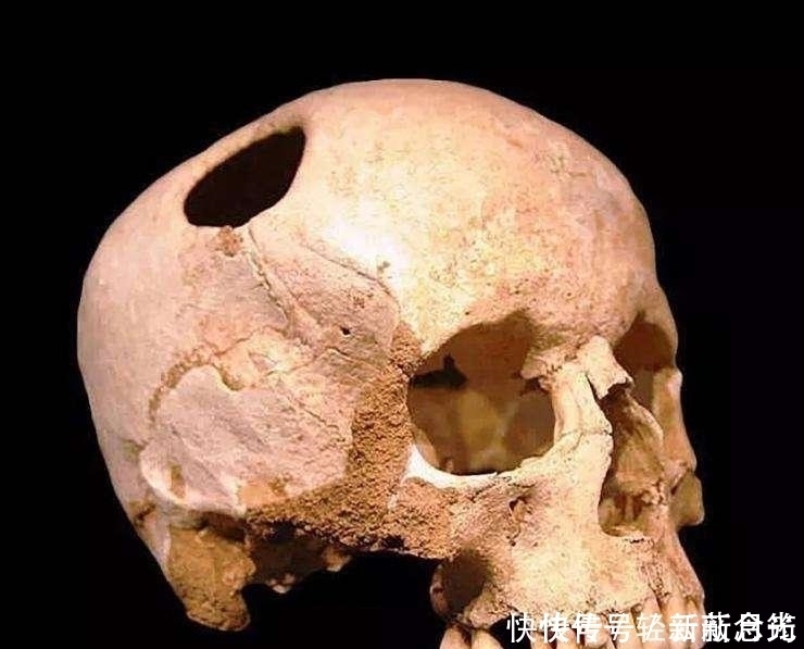 考古发现|若华佗劈开曹操头颅,真能治好他的头疼吗?考古发现给出新证据
