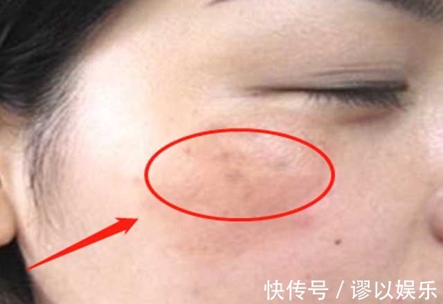 炎症|女人有妇科炎症面部会有3个变化,常喝1杯水,抑菌消炎养子宫