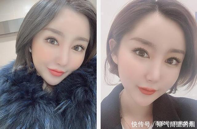 韩国妹子做眼鼻和脂肪填充,网友看到恢复照说侧颜秒杀金泰熙!