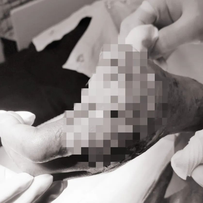 截肢|大爷被这种物品叫刺伤,拇指截肢险丧命,处理它一定要小心!