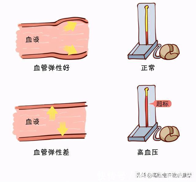 大爷|有高血压的人要注意了,医生:出现这3种状况当心脑出血,要警惕