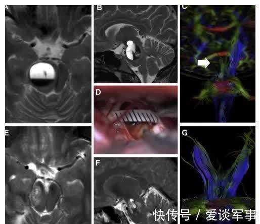 婴孩|孕妈瘫痪,竟是脑干肿瘤出血作祟,脑干手术后诞下婴孩造医学奇迹