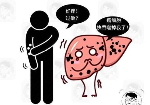 肝脏|以为是过敏，其实是患癌！皮肤若有3个变化，最好做个肝脏CT