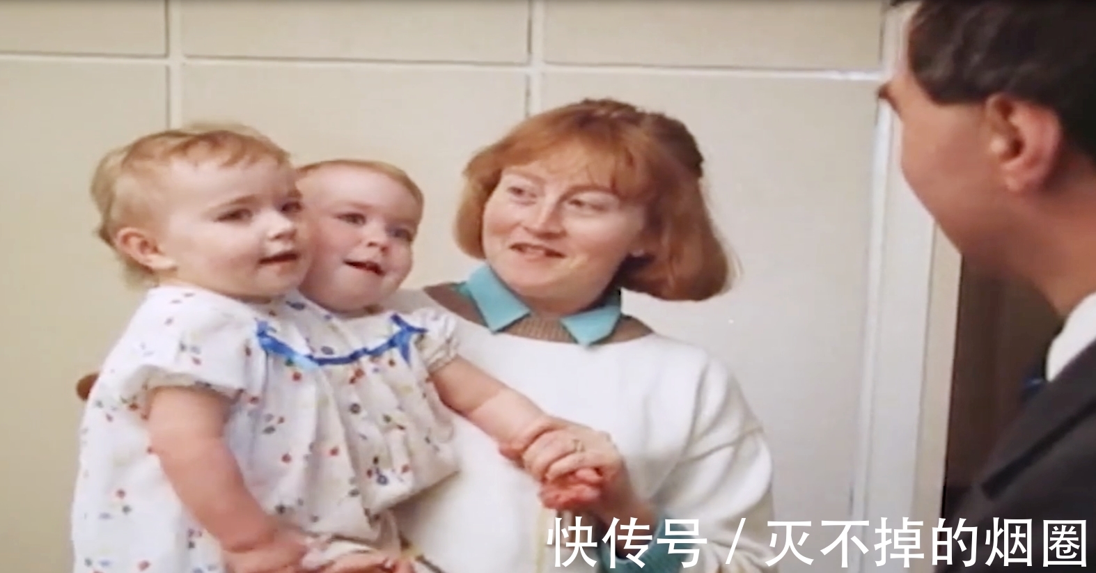 索菲亚|2女孩共用一个躯体生活3年,要将她们个体分离,能成功吗?