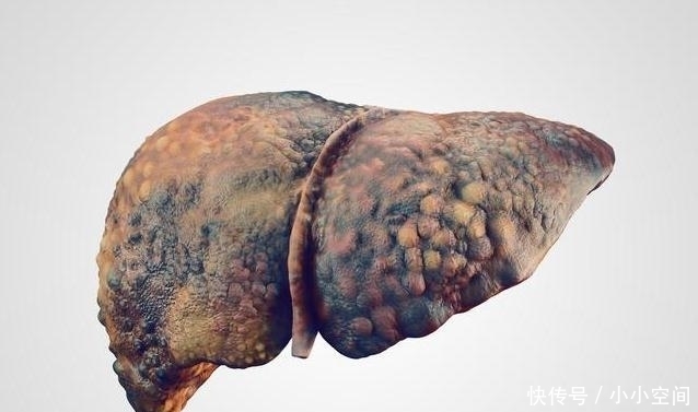 肝癌上身静悄悄?4个症状,是它的“脚步声”,肝炎者要重视