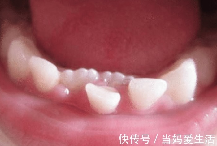 消毒|孩子这颗牙有大“作用”,父母别再乱丢了,关键时刻能救娃一命