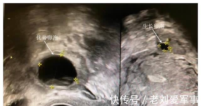 不孕|检查都正常，却迟迟无法怀孕？不明原因不孕，3种方法提高怀孕率