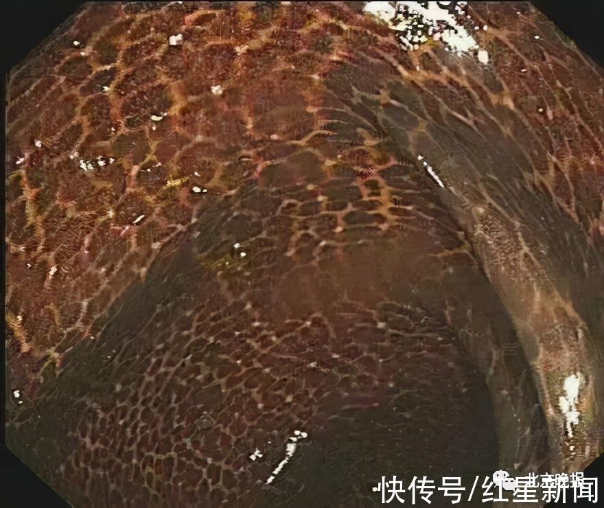 结肠黑变病|豹纹?蛇皮?她吃了3年这种“药”,肠子表面变成…