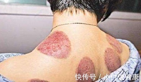 毒素|拔完罐后身上的淤青是身体排出的毒素吗?看看老中医是怎么说的