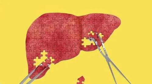 医生|36岁大哥脂肪肝重度,转氨酶从361降到34,医生:3种食物要少吃